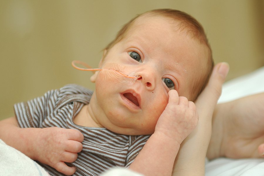 Nasogastric tube feeding baby