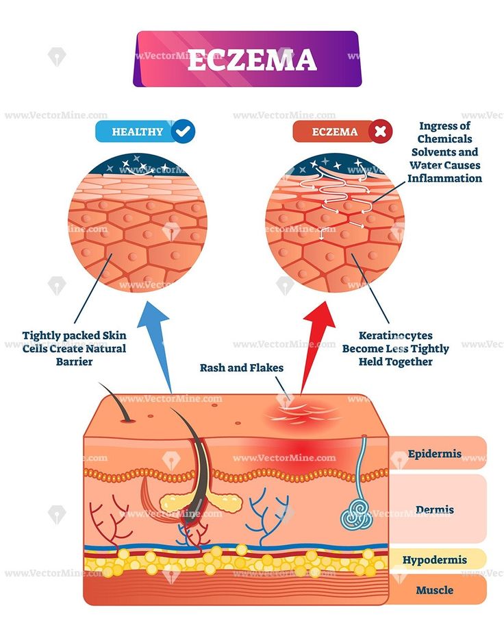 What foods trigger eczema in babies