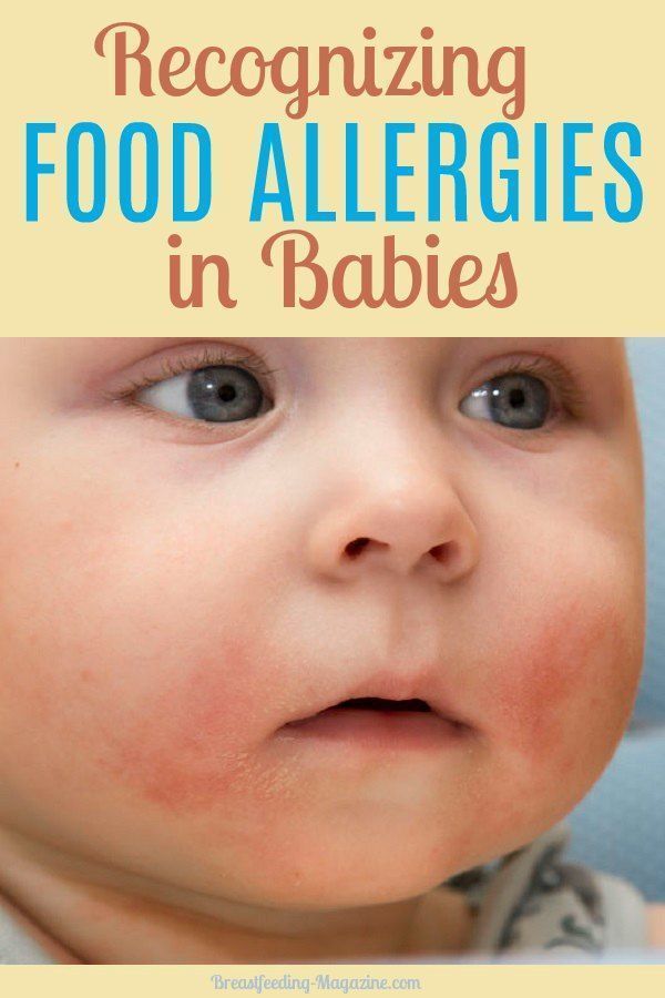 Severe food allergies in babies