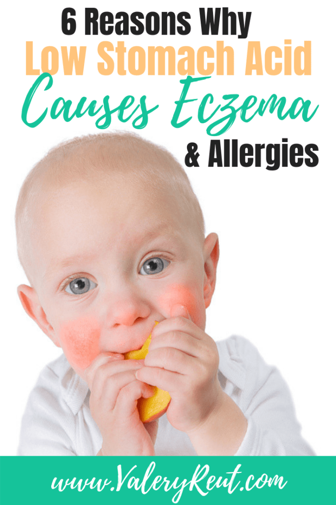 Can food cause eczema in babies