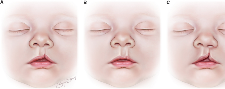 Cleft lip baby feeding