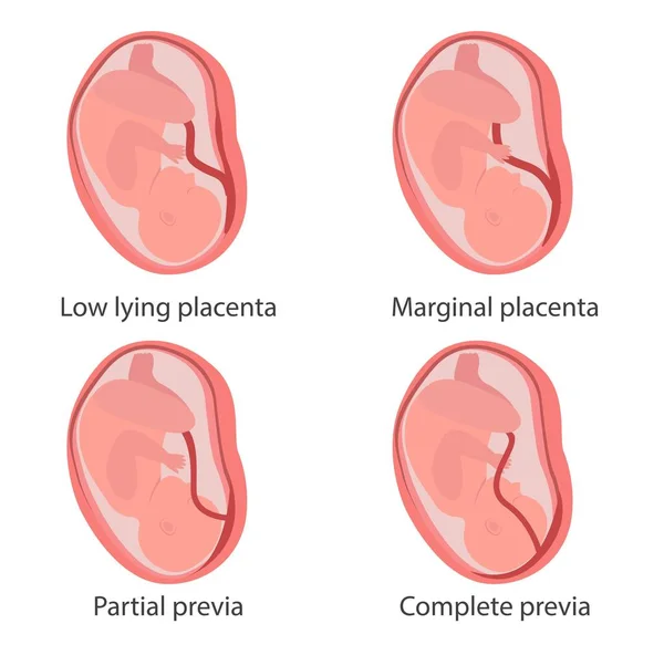 Placenta not feeding baby enough